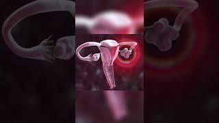 PCOS (polycystic ovarian syndrome) #shorts #ytshorts