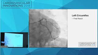 CVI2018 Session: Complex Multivessel PCI - Daniel A. Feldman, MD