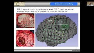 Epilepsy Surgery in Children - Prof Helio Rubens Machado