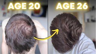 My SHOCKING Hair Regrowth on DERMAROLLER, MINOXIDIL and FINASTERIDE