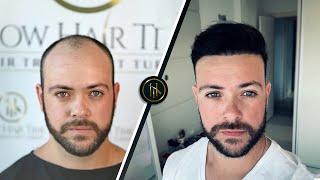 Hair Transplant Before and After | Hair Transplant Results