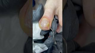 7 недель педикюру с наклейками #nails #маникюр #дизайнногтей #онихолизис #педикюр