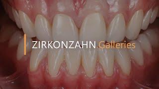 Complete restoration in Prettau® 3 Dispersive® | Zirkonzahn.Galleries