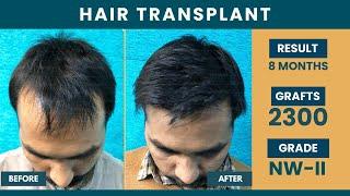 Hair Transplant in Delhi | Best Results | Hair Transplant Cost in Delhi | SkinQure