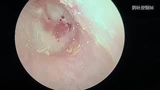 成人的中耳積水、耳鳴、聽力障礙，小心鼻咽癌