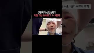 안면거상 수술 후에 지하철 타고 집갑니다 (feat.수술1-3일차)