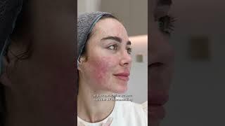 Acne Scars & Pigmentation Treatment