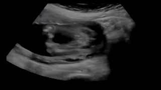 Baby Ultrasound 1 Hour White Noise (Dim Screen)