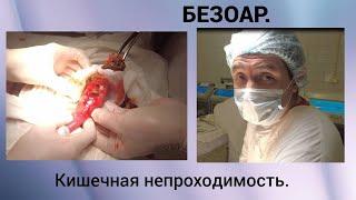 Безоар. Кишечная непроходимость.