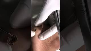 Warts Removal Treatment | Safe and Effective Wart Removal Treatment | Skinaa Clinic #viral #ytshorts