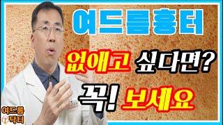 여드름 흉터없애고 싶다면꼭보세요~ #여드름흉터 #여드름흉터없애는방법  #여드름흉터없애는법 #여드름자국