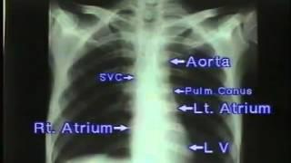 How to read a Chest X ray