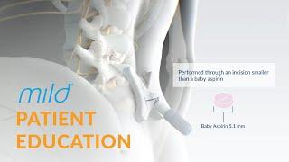 Mild Procedure Patient Education | Minimally Invasive Stenosis Treatment