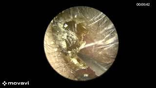 Earwax keeps coming out, part 11! | ENT | Earwax Removal | Ear cleaning | Cerumen Impaction