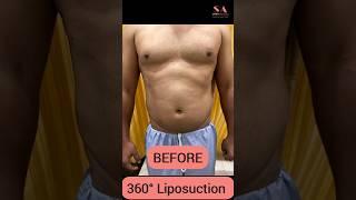 360° Liposuction Surgery Before After | Instant Amazing Results of Liposuction | Shobhit Aesthetics