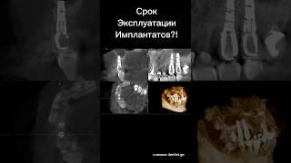 Срок эксплуатации дентальных имплантатов. На примере работ 22х и 20и летней давности, #стоматология