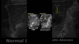 Hepatic Abscess On Ultrasound | Liver Normal Vs Abnormal USG | Abdominal Sonography #shorts