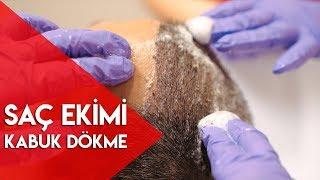 Saç Ekimi - Kabuk Dökme İşlemi