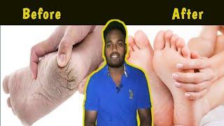 cracked Heels () Problem One medicine || country drug vignesh