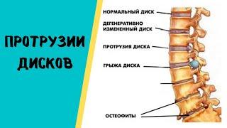Протрузии дисков - это норма? #Shorts