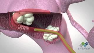 How Fibroids Are Treated - New Animation From NYC Surgical Associates