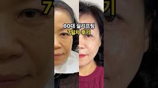 60대 실리프팅 시술후기&경과️ #shorts#실리프팅#민트실리프팅