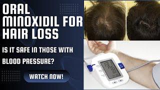 Minoxidil for hair loss | can we use in those with blood pressure?