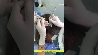 Biofibre hair implant in Dubai By Dr.abbas Ashrafzadeh ( biofiber hair implant)