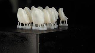 100 micron thick 3D printed veneers