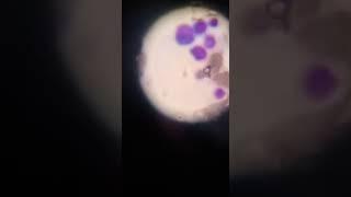 Blast Cells Seen in CBC Smear | Case Diagnosed Acute Leukemia | Hematology Section Leukemia Slides