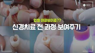 신경치료 과정 처음부터 끝까지 직접 보여드립니다