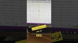 تخطيط الدماغ و رسم المخ EEG  #مخ #اكسبلور #الصرع