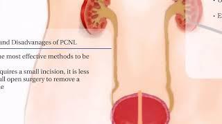 PCNL