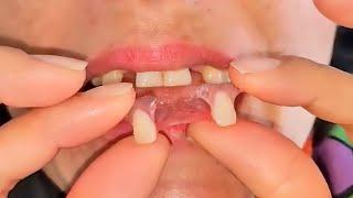 How To Remove The Palate From A Dental Prosthesis