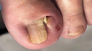 Endured for over a year! Ingrown toenail that pierces the flesh