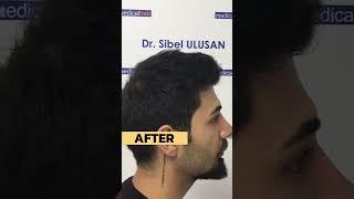 Embrace a New Beginning with Hair Transplant!