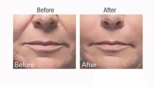 Botox vs Dermal Fillers