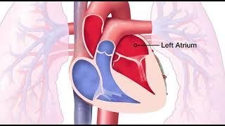 Mitral Valve Regurgitation