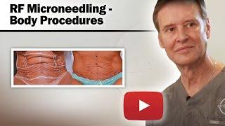 Profound RF Microneedling - Body Procedures - Louisville Microneedling