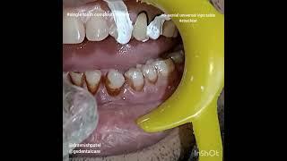 Composite Veneer  | GC India | GC G-aenial Universal Injecatable technique | Exaclear | Dr Avnish