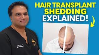 Hair Transplant Shedding EXPLAINED - What You Need To Know!