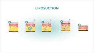Liposuction Procedure - Plastic Surgery in Houston
