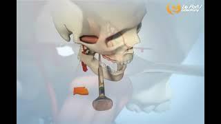 lefort 1 osteotomy orthognathic