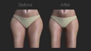 NYC Surgical Associates Shares Total Leg Makeover With Micro Liposuction, Vein Removal