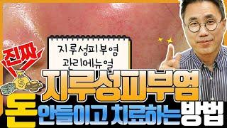 지루성피부염 관리 메뉴얼을 공개합니다. 지루성피부염은 체계적으로 관리해야 합니다.