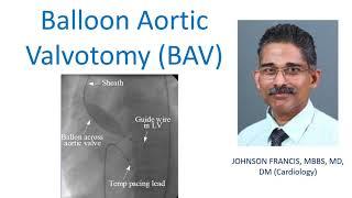 Balloon Aortic Valvotomy (BAV)