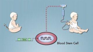 Stem Cell Cure for "Bubble Baby" Disease (SCID), Pioneered by UCLA's Don Kohn