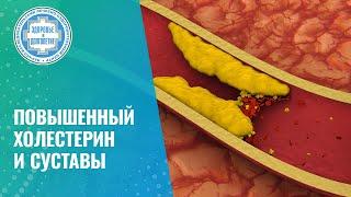 ‍️ Влияет ли повышенный холестерин на суставы?