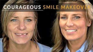 Broken Teeth to Brave Smile - Dental Veneer Makeover by Brighter Image Lab - NO Cosmetic Dentist