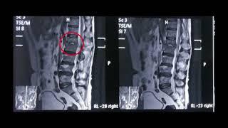 Patient Success Story | Spine Surgery | Dr Sahil Batra | Best Spine Surgeon In Punjab